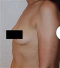 Breast Augmentation - Centro Médico Quirúrgico Estethica