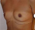 Breast Augmentation - Centro Médico Quirúrgico Estethica
