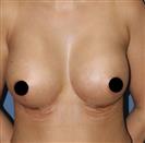Breast Reduction - Centro Médico Quirúrgico Estethica