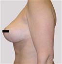 Breast Reduction - Centro Médico Quirúrgico Estethica