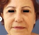 Eyelid Aesthetics (Blepharoplasty) - Centro Médico Quirúrgico Estethica