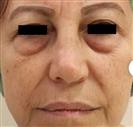 Eyelid Aesthetics (Blepharoplasty) - Centro Médico Quirúrgico Estethica