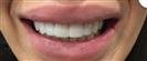 Teeth Whitening - Centro Médico Quirúrgico Estethica