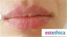 Lip Enhancement (Lip Augmentation) - Centro Médico Quirúrgico Estethica