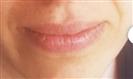 Lip Enhancement (Lip Augmentation) - Centro Médico Quirúrgico Estethica