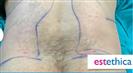 Liposuction (Abdominal) - Centro Médico Quirúrgico Estethica