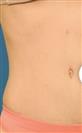 Tummy Tuck (Abdominoplasty) - Centro Médico Quirúrgico Estethica