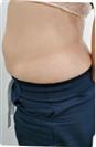 Abdominoplasty (Tummy Tuck) - Centro Médico Quirúrgico Estethica