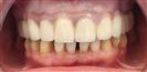 Dental Implants - Clínica West Dental