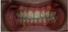 Dental Implants - Clínica West Dental