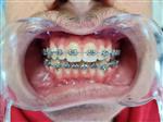 Dental Braces - Clínica West Dental