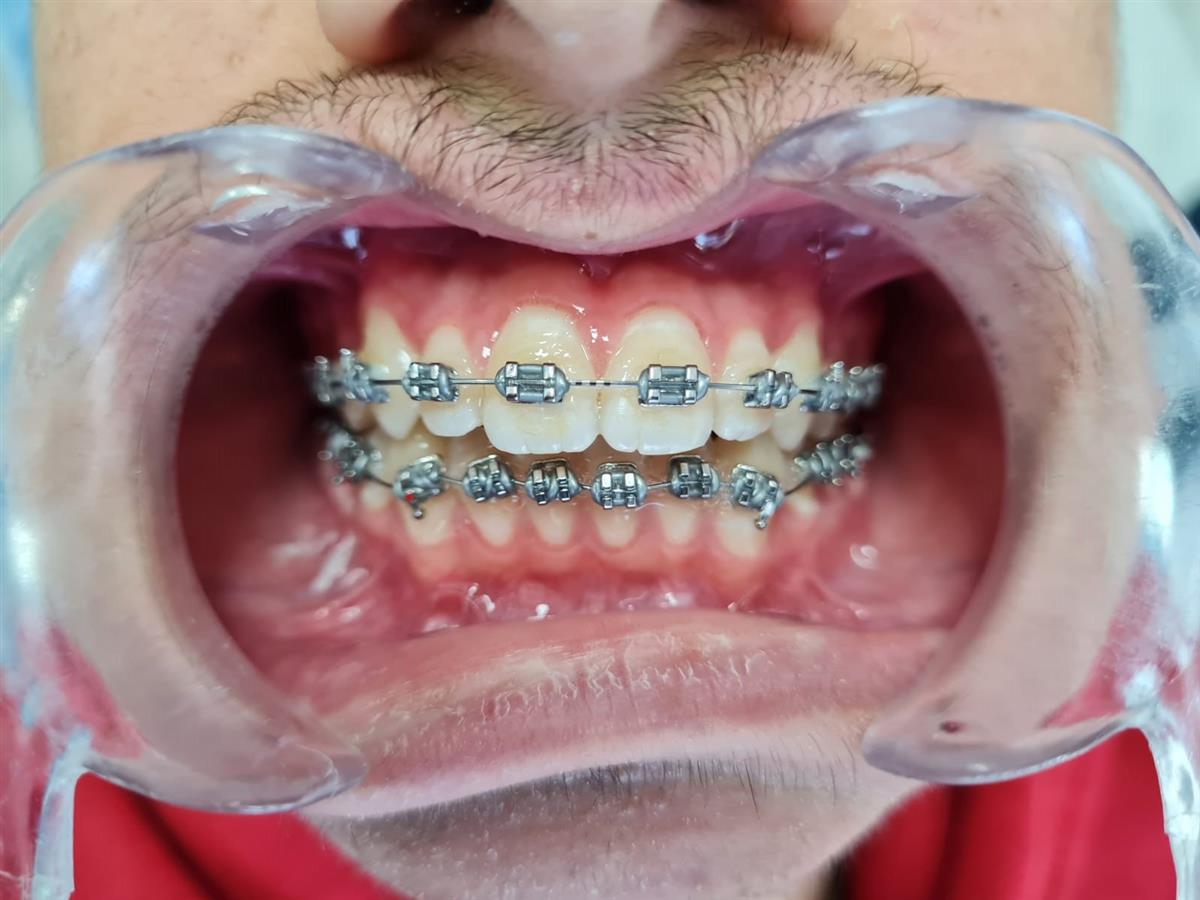 Dental Braces - Clínica West Dental