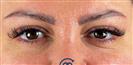Eyelid Surgery - Clínica Cayra