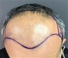 FUE Hair Transplant - Clínica Cayra