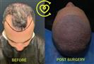 FUE Hair Transplant - Clínica Cayra