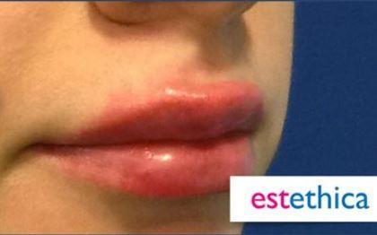 Dermal Fillers